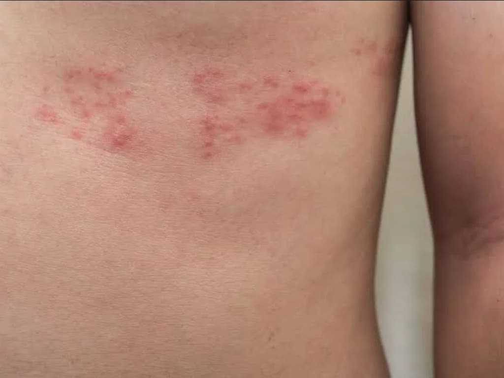 Shingles medical illustration