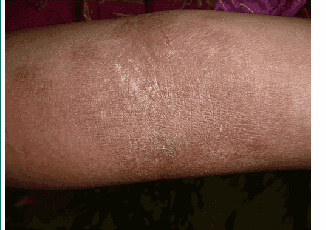 Atopic eczema