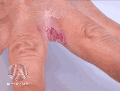 Skin yeast (candida)
