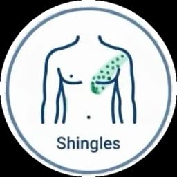 Shingles